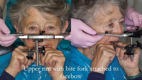 Solving Linda’s Failed “All on 4” implant bridges - full protocol Newsletter 42