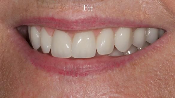 Newsletter 68 Restoring Jan’s Smile: Complete Dentures Inspired by Her Daughter’s Teeth - Post Mouth Surgery