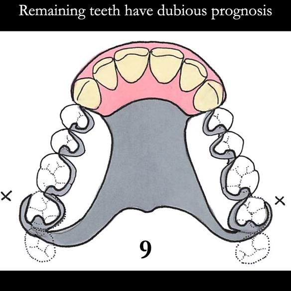 Universal Scandinavian partial denture designs