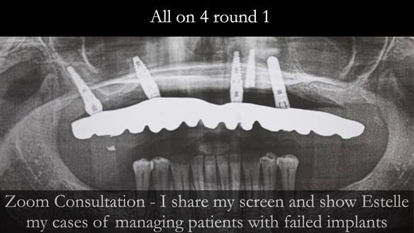 Newsletter 49 Managing Estelle’s failing implants with dentures FULL PROTOCOL