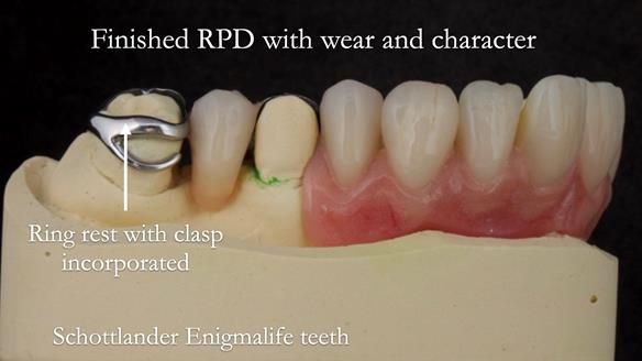 Eileen's transformation with upper and lower RPDs of Scandinavian hygienic design FULL PROTOCOL