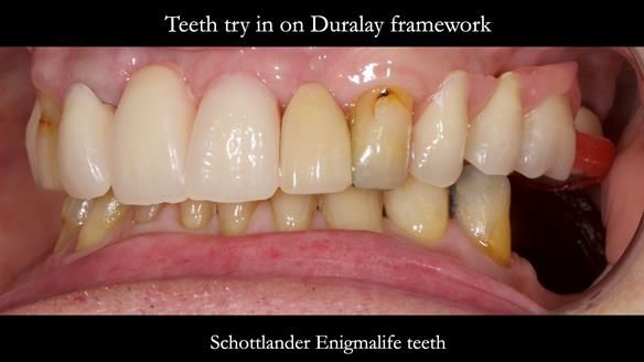 Managing Edgar “THE SCEPTIC” with an RPD/Splint FULL CASE