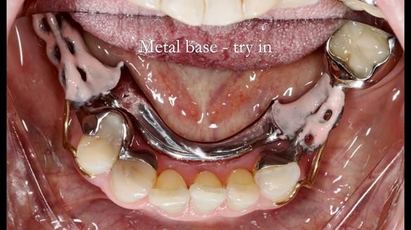 Eileen's transformation with upper and lower RPDs of Scandinavian hygienic design FULL PROTOCOL