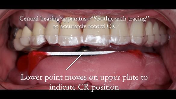 Newsletter 44 - extreme removable prosthodontics – engineering a super-strong and ultra-thin over denture