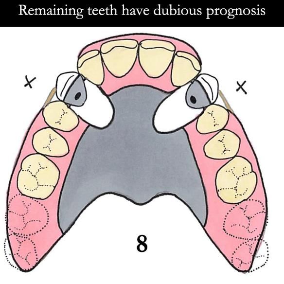 Universal Scandinavian partial denture designs