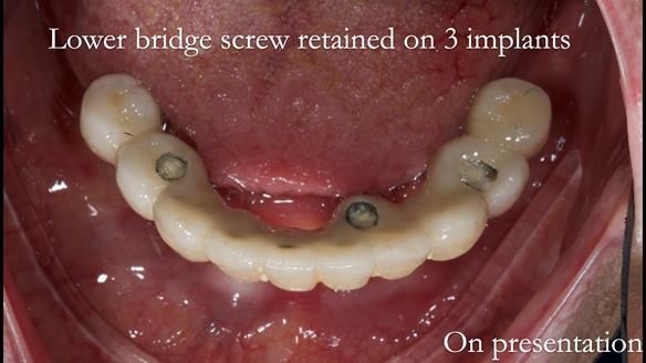 Newsletter 49 Managing Estelle’s failing implants with dentures FULL PROTOCOL