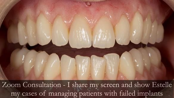 Newsletter 49 Managing Estelle’s failing implants with dentures FULL PROTOCOL