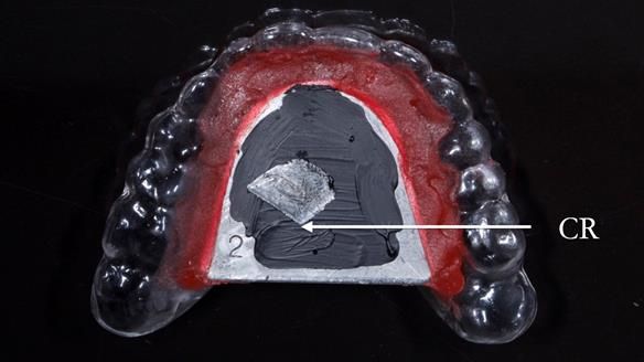 Newsletter 44 - extreme removable prosthodontics – engineering a super-strong and ultra-thin over denture