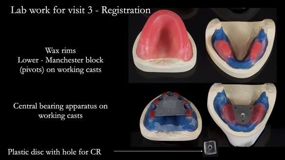 Newsletter 70 Complete Denture Treatment for Kate: A Case Study on Natural-Looking Dentures and Implant-Supported Overdentures