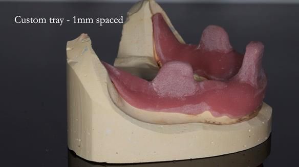 Newsletter 44 - extreme removable prosthodontics – engineering a super-strong and ultra-thin over denture