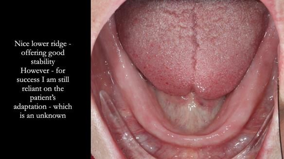 Newsletter 70 Complete Denture Treatment for Kate: A Case Study on Natural-Looking Dentures and Implant-Supported Overdentures