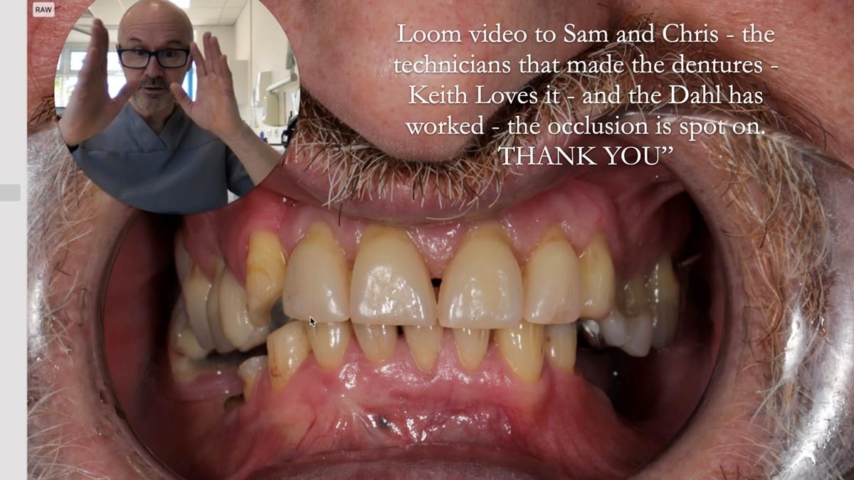 How Keith’s combat denture transformed his life – Newsletter 73