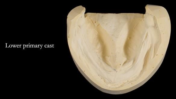 Newsletter 68 Restoring Jan’s Smile: Complete Dentures Inspired by Her Daughter’s Teeth - Post Mouth Surgery