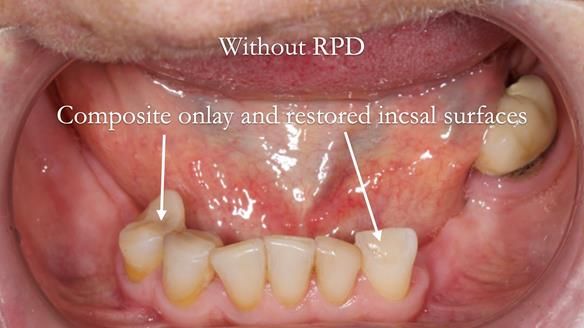 Eileen's transformation with upper and lower RPDs of Scandinavian hygienic design FULL PROTOCOL