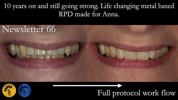 Newsletter 66 Long term case study. Life changing metal based RPD made for Anna