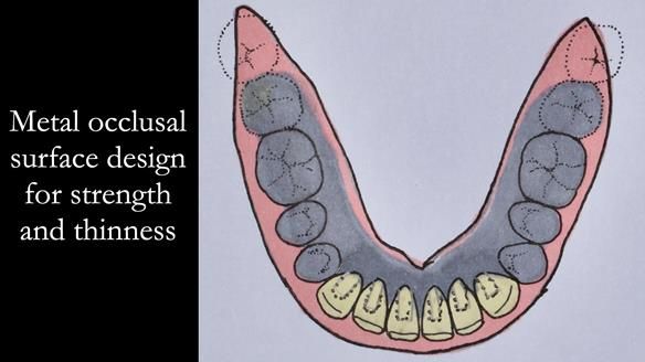 Newsletter 44 - extreme removable prosthodontics – engineering a super-strong and ultra-thin over denture