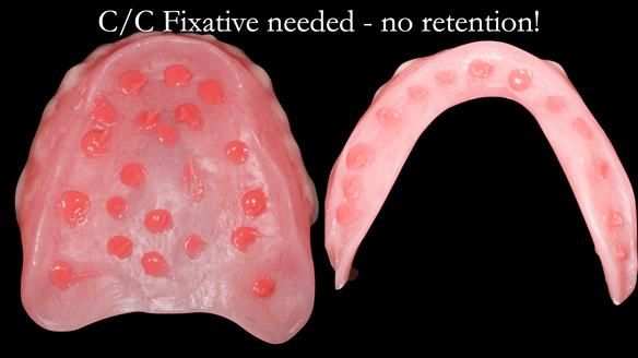 Replacing Madeline’s Complete denture FULL PROTOCOL