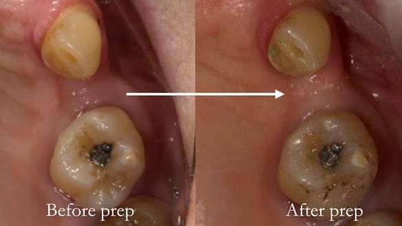 Newsletter 71 Jean’s Class I Mod III RPD: See my mistakes Fractured Mk1 to a Stronger Mk2 RPD (4 years on)