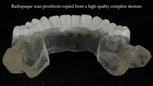 Newsletter 70 Complete Denture Treatment for Kate: A Case Study on Natural-Looking Dentures and Implant-Supported Overdentures