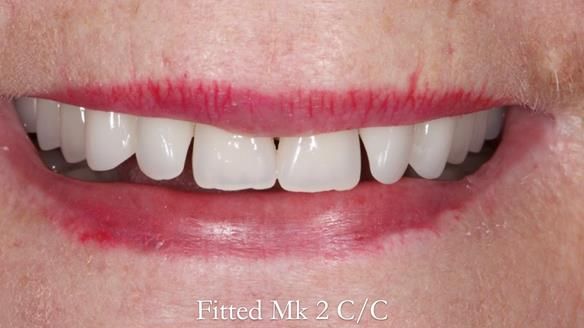 Replacing Madeline’s Complete denture FULL PROTOCOL