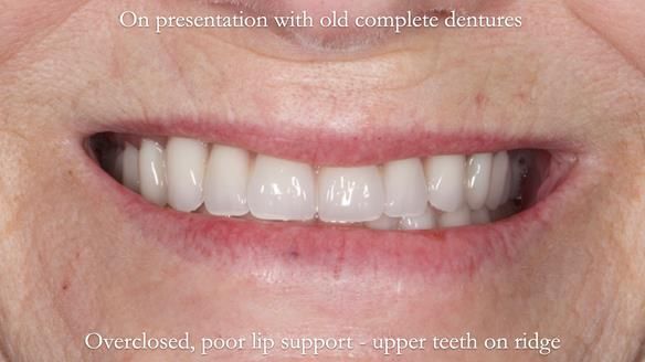 Newsletter 70 Complete Denture Treatment for Kate: A Case Study on Natural-Looking Dentures and Implant-Supported Overdentures