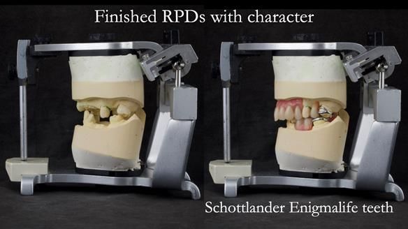 Eileen's transformation with upper and lower RPDs of Scandinavian hygienic design FULL PROTOCOL