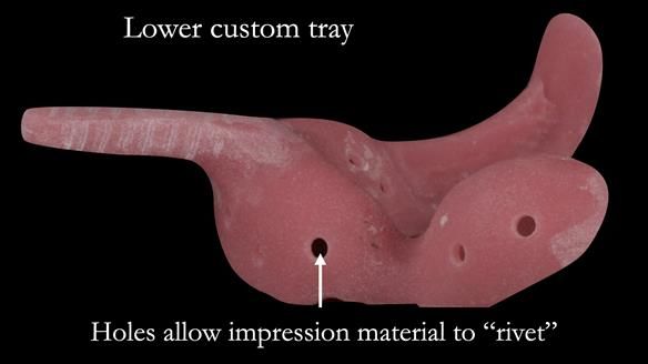 Eileen's transformation with upper and lower RPDs of Scandinavian hygienic design FULL PROTOCOL