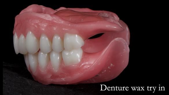 Newsletter 65 Marisa Provision of Complete Dentures on badly placed implants