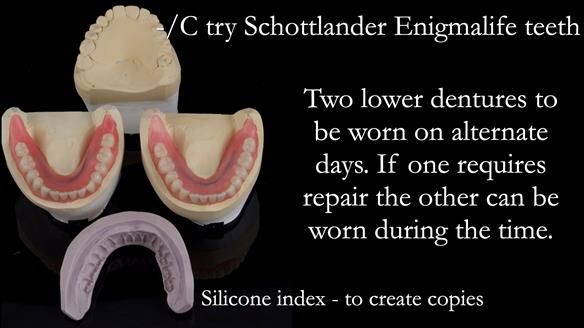 Newsletter 44 - extreme removable prosthodontics – engineering a super-strong and ultra-thin over denture