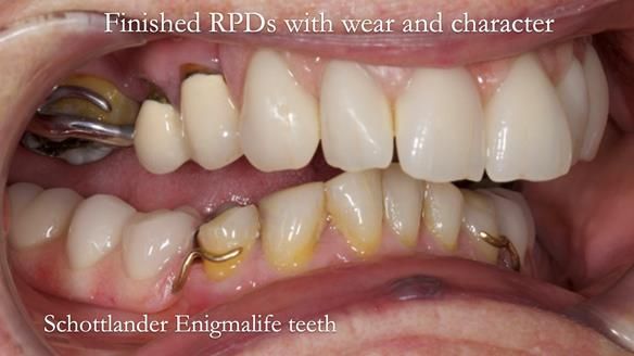 Eileen's transformation with upper and lower RPDs of Scandinavian hygienic design FULL PROTOCOL