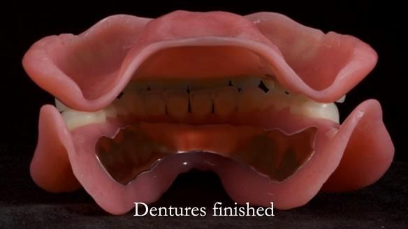 Newsletter 70 Complete Denture Treatment for Kate: A Case Study on Natural-Looking Dentures and Implant-Supported Overdentures