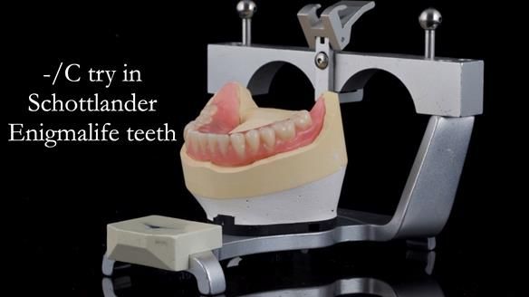 Newsletter 44 - extreme removable prosthodontics – engineering a super-strong and ultra-thin over denture