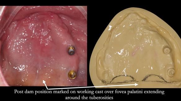 Solving Linda’s Failed “All on 4” implant bridges - full protocol Newsletter 42