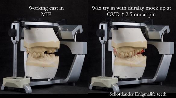 Read Newsletter 67 - Brian's COMBAT DENTURE Case Study