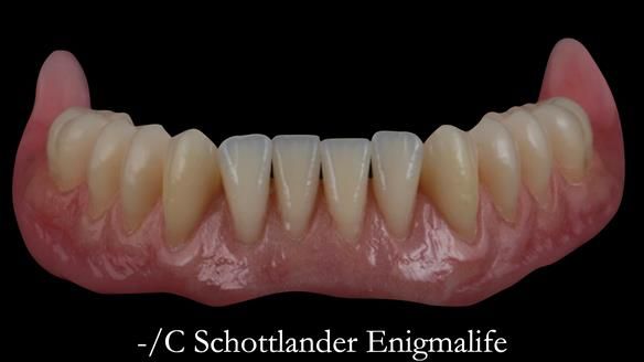 Newsletter 48 Mavis's Complete denture FULL PROTOCOL