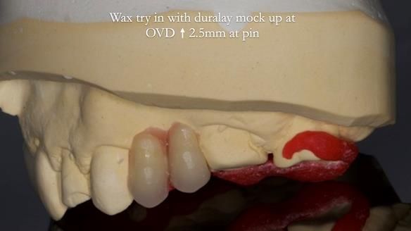 Read Newsletter 67 - Brian's COMBAT DENTURE Case Study