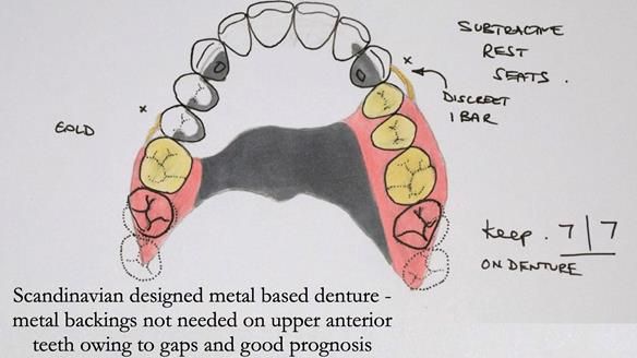 Solving Sue's failed implants with metal based RPD - full protocol Newsletter 43