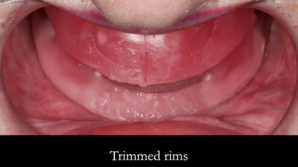 Replacing Madeline’s Complete denture FULL PROTOCOL