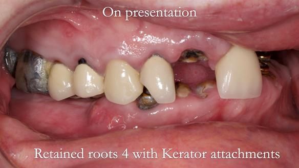 Newsletter 44 - extreme removable prosthodontics – engineering a super-strong and ultra-thin over denture