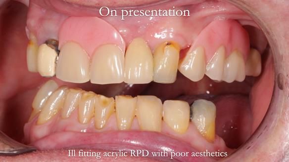 Managing Edgar “THE SCEPTIC” with an RPD/Splint FULL CASE