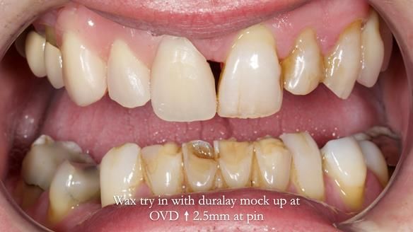 Read Newsletter 67 - Brian's COMBAT DENTURE Case Study