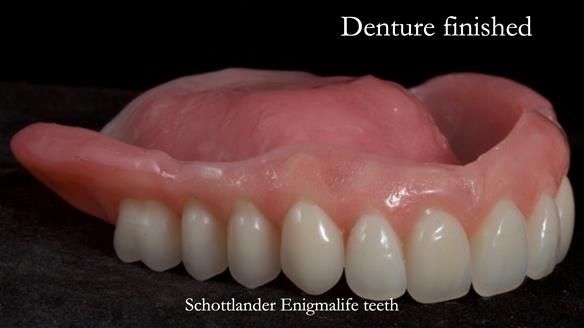 Newsletter 70 Complete Denture Treatment for Kate: A Case Study on Natural-Looking Dentures and Implant-Supported Overdentures