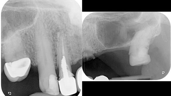 Managing Edgar “THE SCEPTIC” with an RPD/Splint FULL CASE