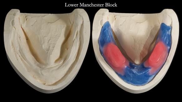 Newsletter 68 Restoring Jan’s Smile: Complete Dentures Inspired by Her Daughter’s Teeth - Post Mouth Surgery