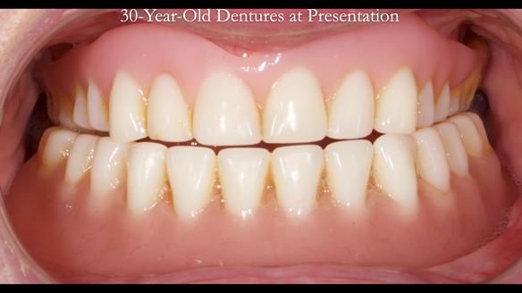 Newsletter 68 Restoring Jan’s Smile: Complete Dentures Inspired by Her Daughter’s Teeth - Post Mouth Surgery