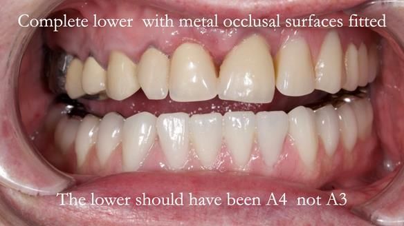 Newsletter 44 - extreme removable prosthodontics – engineering a super-strong and ultra-thin over denture