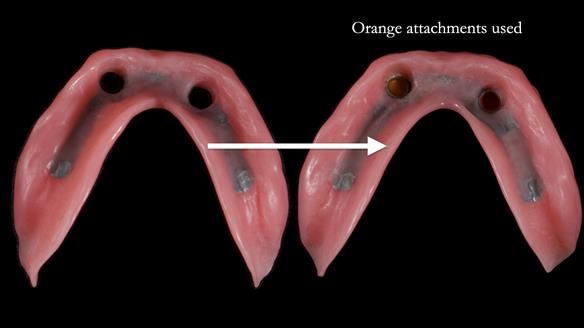 Newsletter 65 Marisa Provision of Complete Dentures on badly placed implants