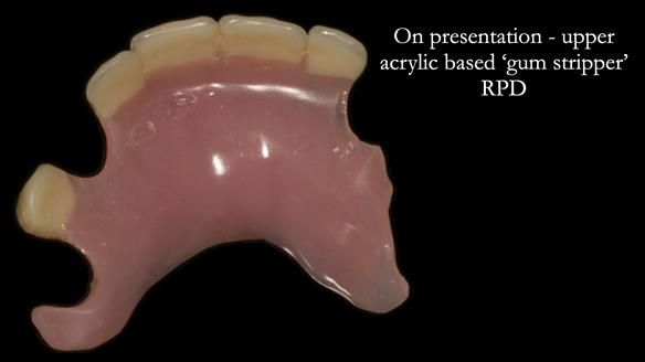 Newsletter 71 Jean’s Class I Mod III RPD: See my mistakes Fractured Mk1 to a Stronger Mk2 RPD (4 years on)