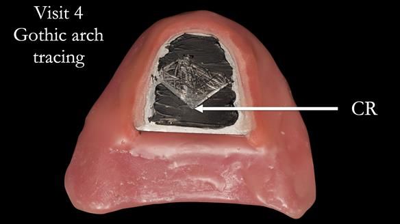 Newsletter 49 Managing Estelle’s failing implants with dentures FULL PROTOCOL