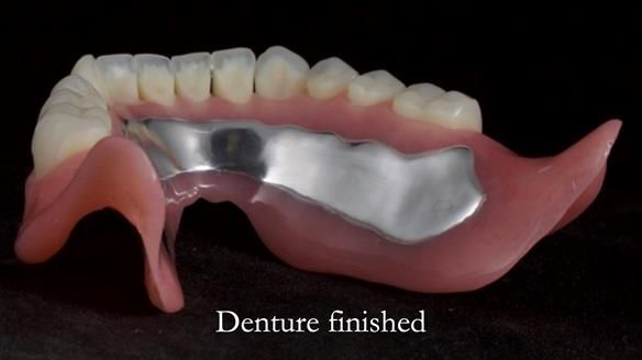 Newsletter 70 Complete Denture Treatment for Kate: A Case Study on Natural-Looking Dentures and Implant-Supported Overdentures